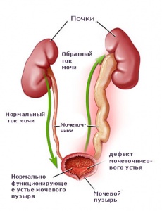 Пузырно-мочеточниковый рефлюкс, рефлюксы в почках - лечение коррекция